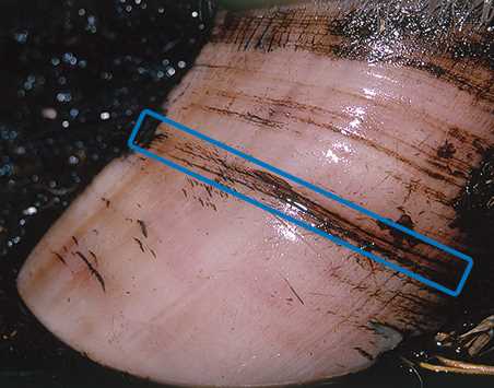 Horizontal Fissure Severity 1